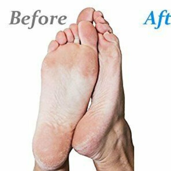 Emjoi Micro Pedi White Callus Remover with Extra Coarse Roller & Cleaning Brush - Picture 4 of 9